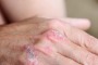 Salute: psoriasi, 42% dei pazienti è discriminato sul lavoro