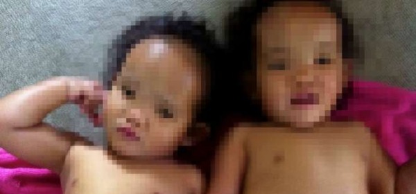 Binh e Phuoc, le gemelline malate che attendono un trapianto