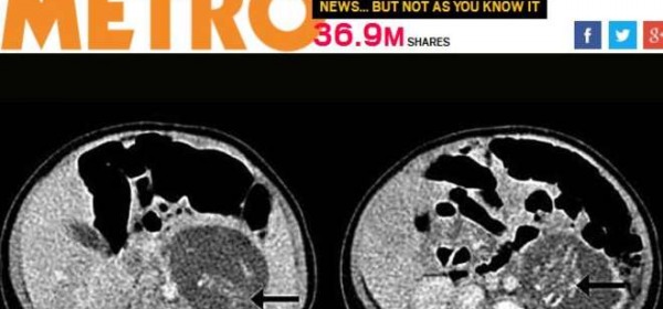 La neonata incita di due gemelli