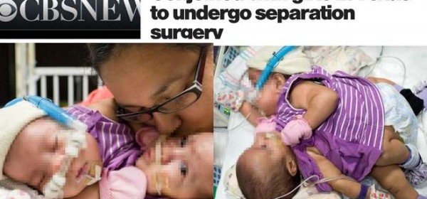 Knatalye Hope e Adeline Faith Mata, le gemelline siamesi salvate (CbsNews)