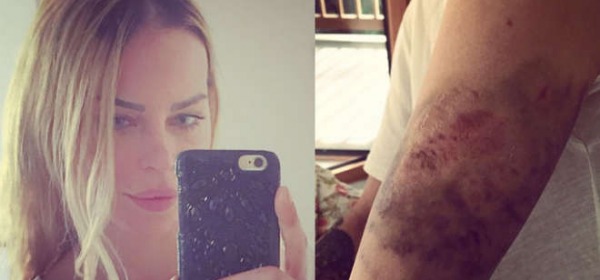Nina Moric e gli ematomi della caduta (Instagram)