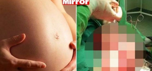 Pensa di essere incinta, ma è un cancro gigante (Mirror)