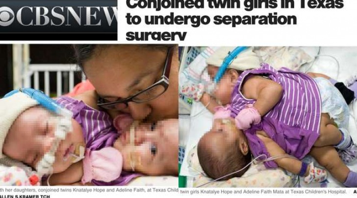 Knatalye Hope e Adeline Faith Mata, le gemelline siamesi salvate (CbsNews)