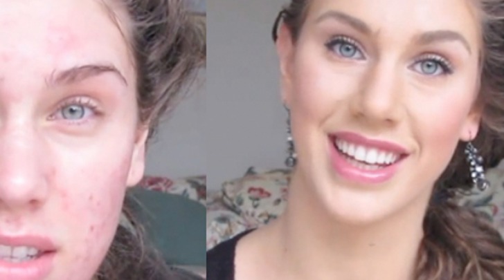 Acne Il Rimedio Da 9 Milioni Di Visualizzazioni Di Cassandra Bankson 