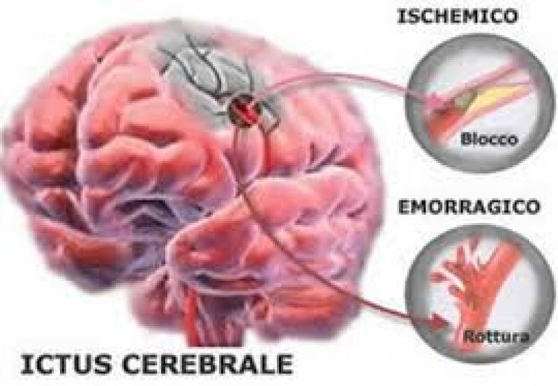 Menús para personas con ictus